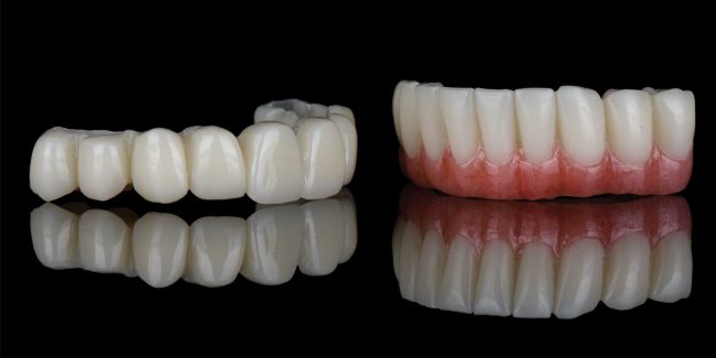 do-dental-implants-last-Bonacci-periodontics-dental-implants Do dental implants last forever? | Bonacci Periodontal Implants