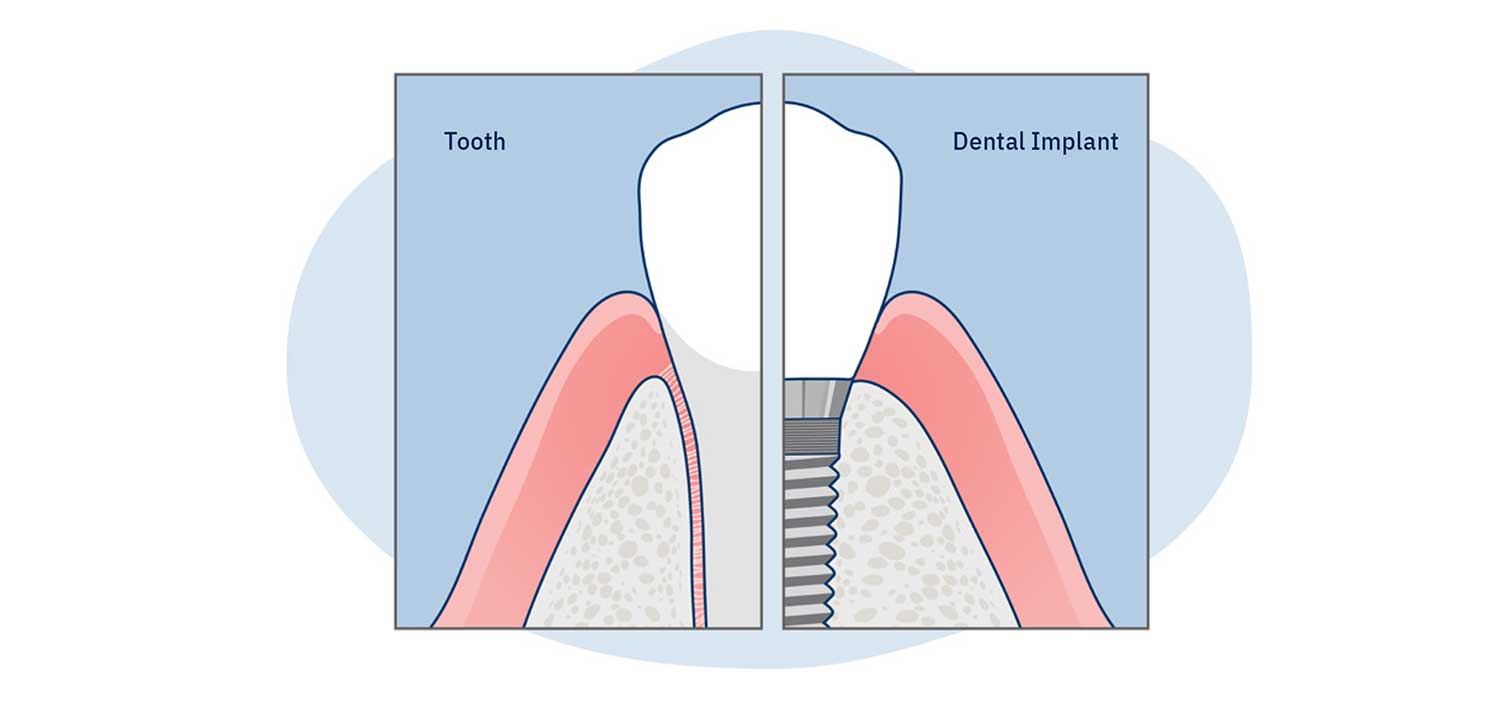 What causes bone loss around dental implants? | Bonacci Periodental Implants
