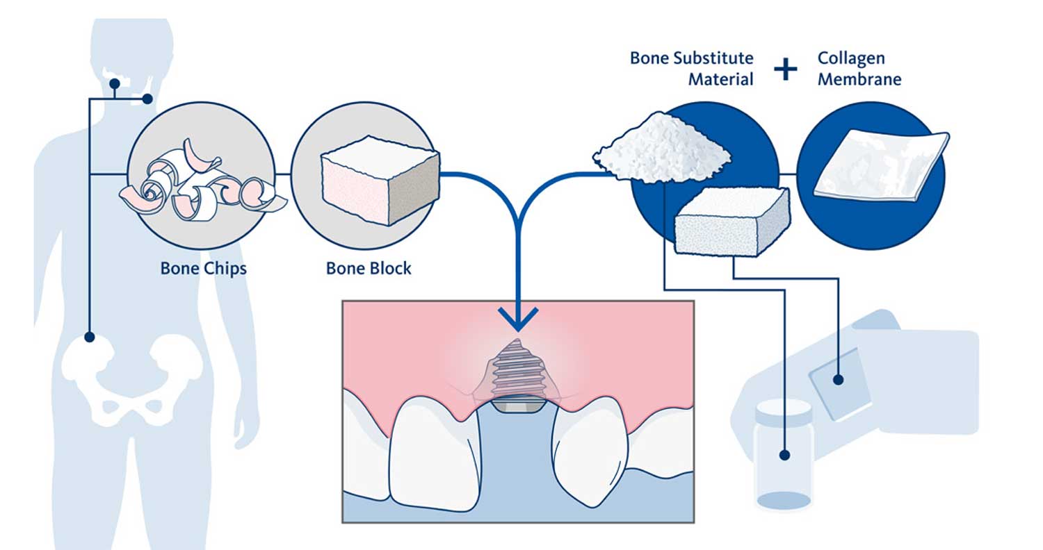 Bone Grafting Harvesting | Bonacci Periodental Implants