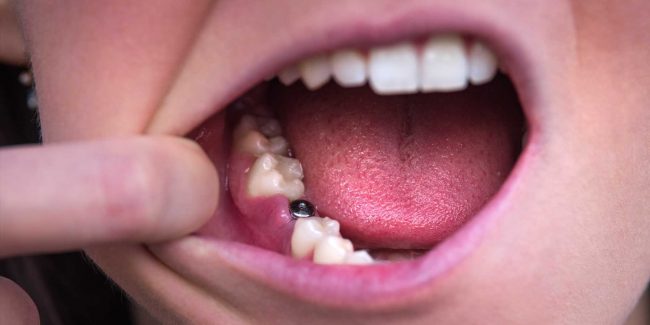 multiple-tooth-dental-implants-Bonacci-periodontics-dental-implants The Difference Between Single-Tooth, Multiple-Teeth, And Full-Mouth Dental Implants | Bonacci Periodental Implants