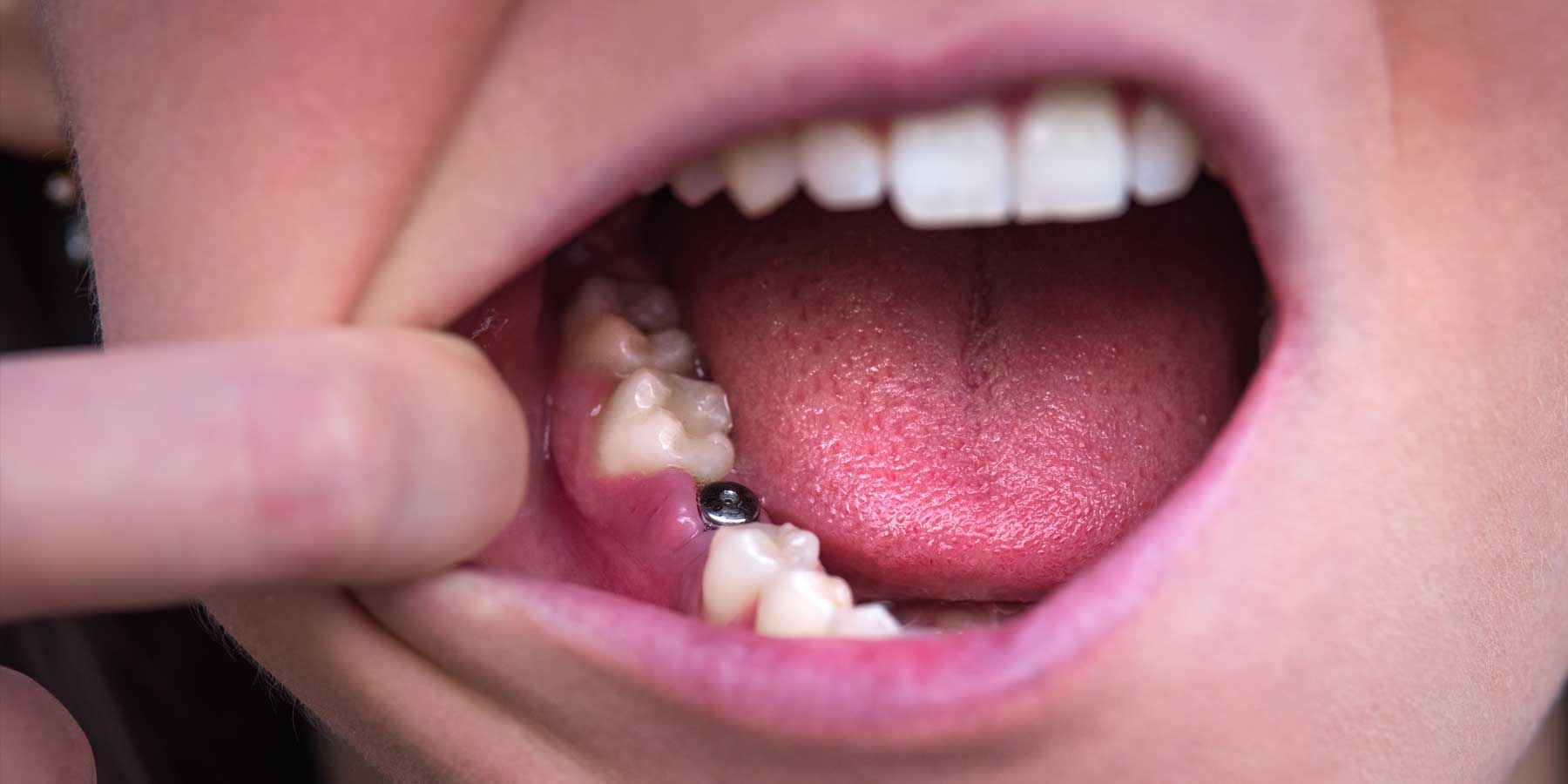 multiple-tooth-dental-implants-Bonacci-periodontics-dental-implants The Difference Between Single-Tooth, Multiple-Teeth, And Full-Mouth Dental Implants | Bonacci Periodental Implants